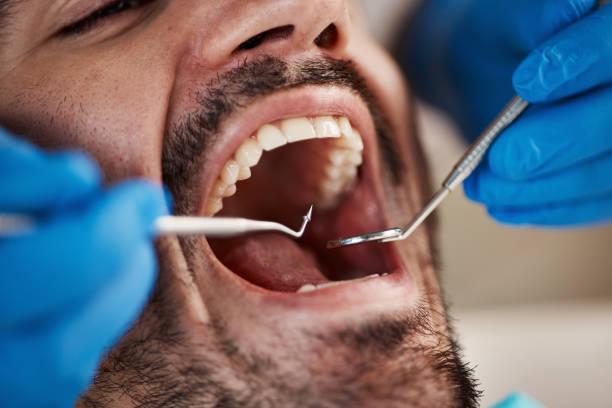 Best Emergency Tooth Extraction in Huntersville, NC